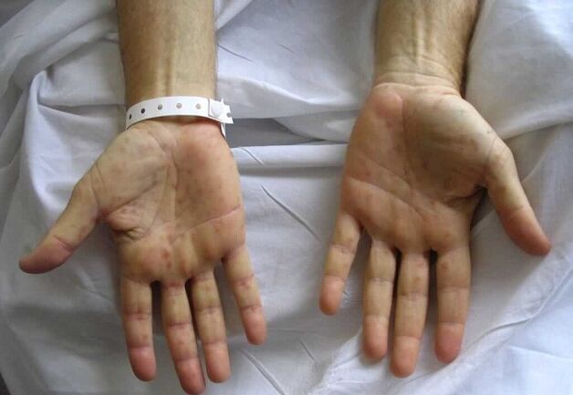 syphilis on the hands as the cause of pathological discharge from the penis